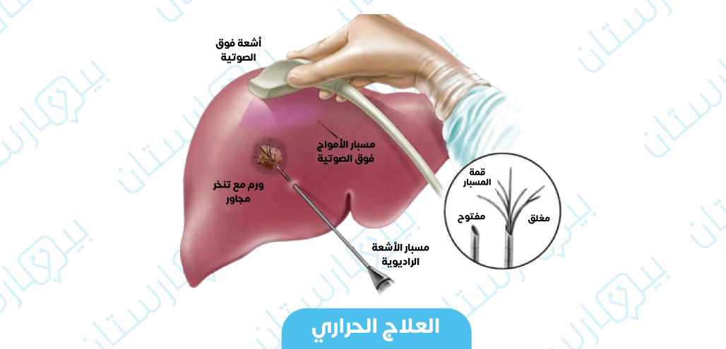 وضع مسبار الأمواج فوق الصوتية مع مسبار الأشعة الراديوية لتسخين الورم وتدميره