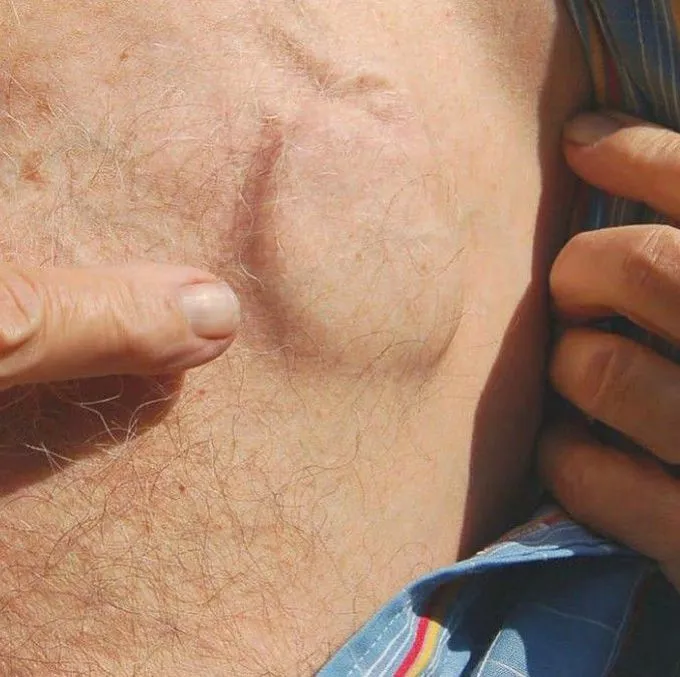 The defibrillator is implanted directly under the skin, so it appears as a protrusion in the skin of the chest