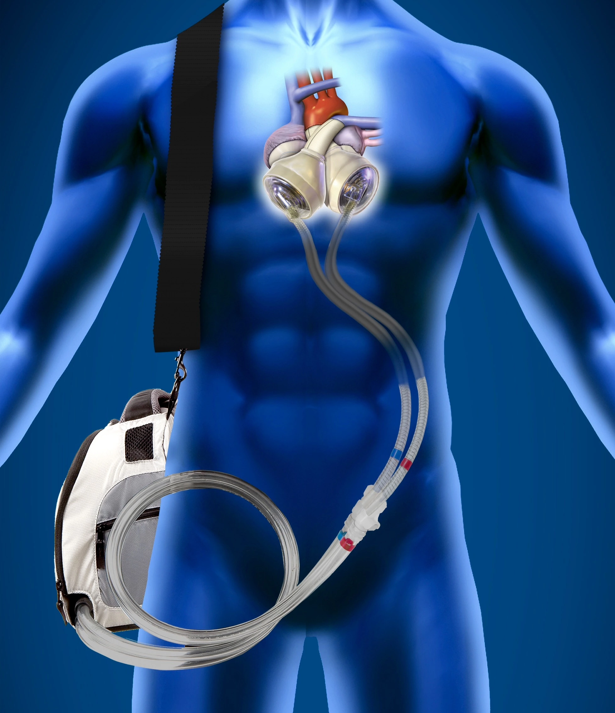 The artificial heart is located in the place of the natural heart in the patient's chest and is connected through tubes to a monitoring device outside the body that the patient carries at all times