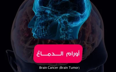 Brain tumors symptoms and causes