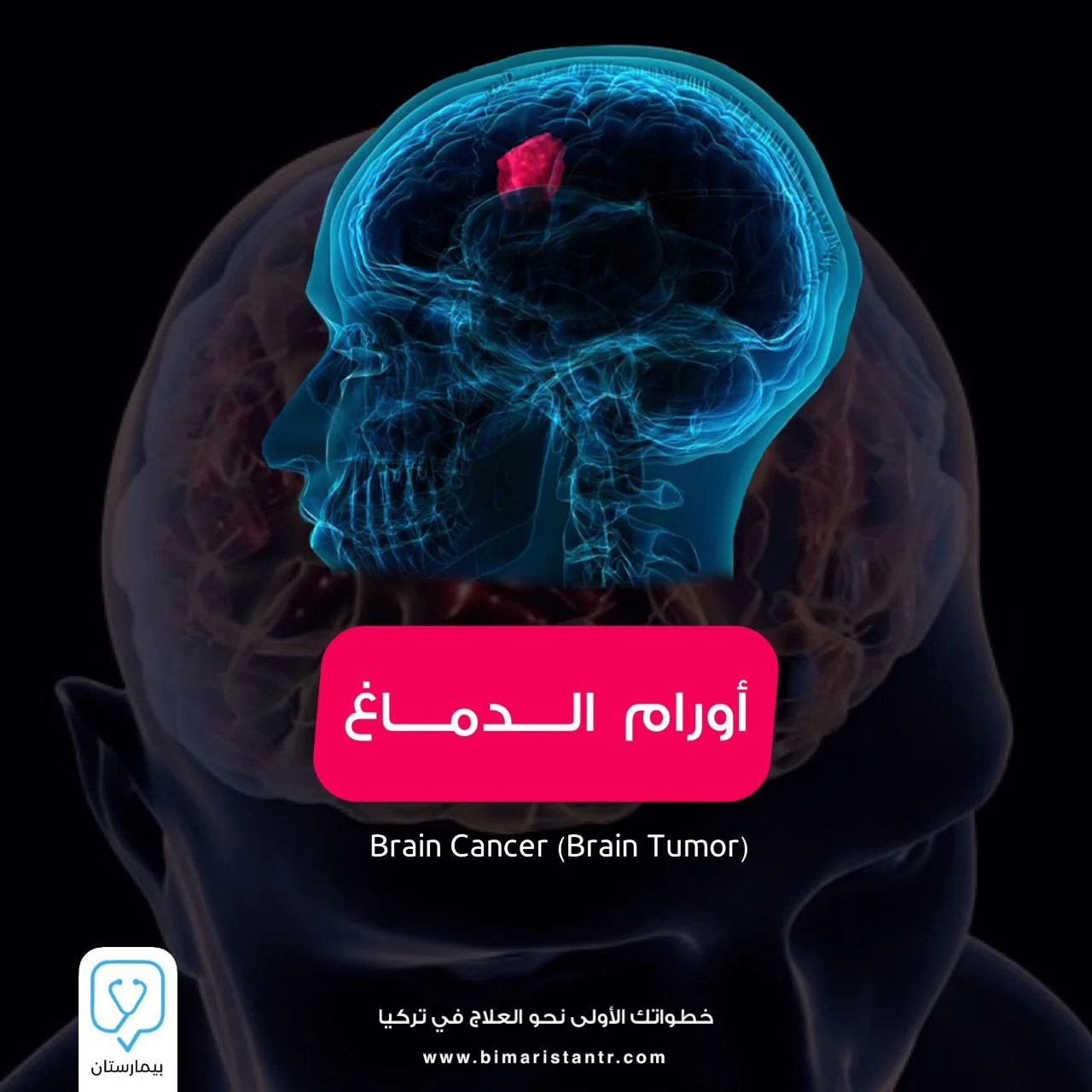 أورام الدماغ الأعراض والأسباب والعلاج في تركيا - بيمارستان