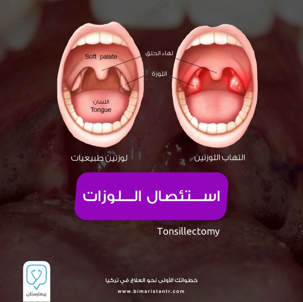 Tonsillectomy in Turkey