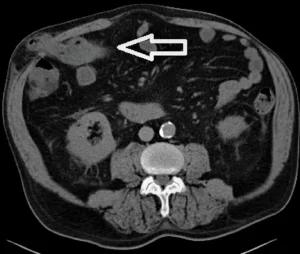 Computed tomography (CT) scan of abdominal hernia