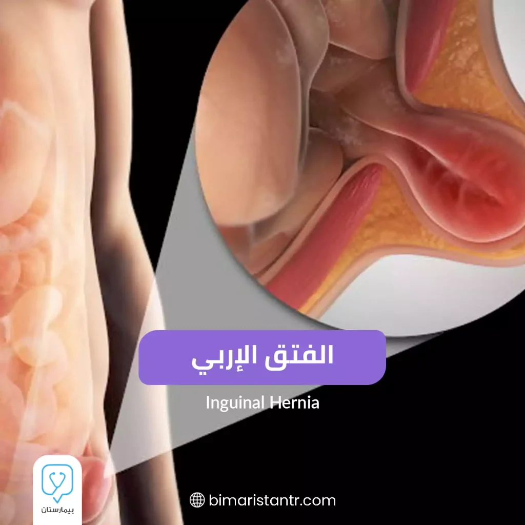 Inguinal hernia in children/ Symptoms and treatment in Turkey/