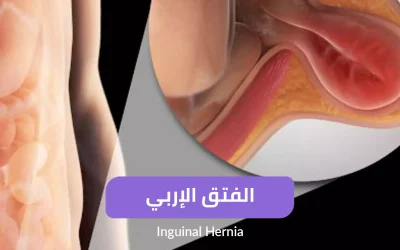 Inguinal hernia - inguinal hernia in children - symptoms and treatment