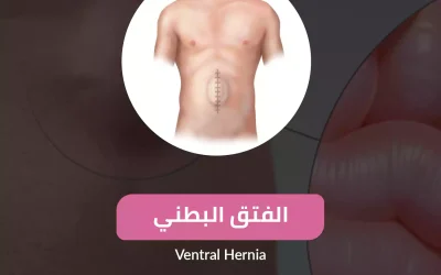 Abdominal hernia treatment