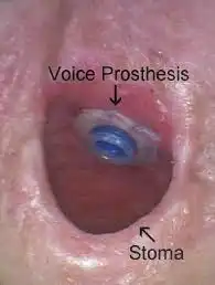 stoma in the larynx 