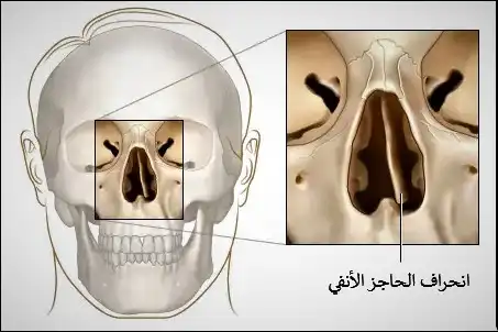 انحراف الحاجز الأنفي