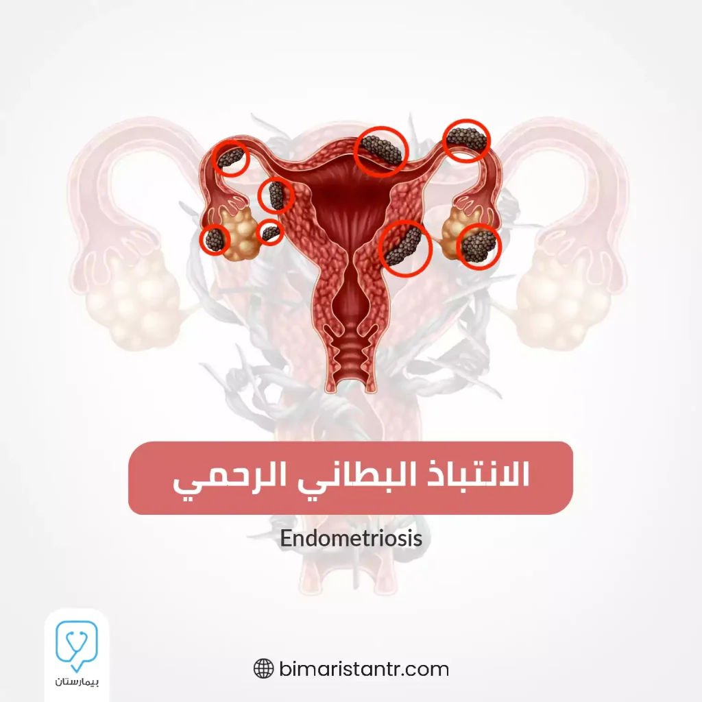 Endometriosis-migratory disease