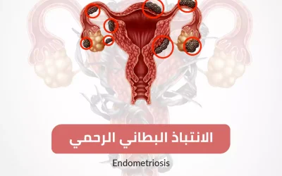 endometriozis hastalığı