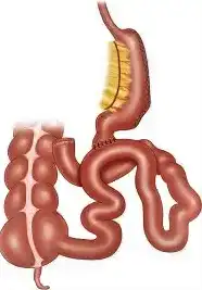 Duodenal switch surgery Traditional duodenal switch surgery where the stomach is attached to the end of the intestine