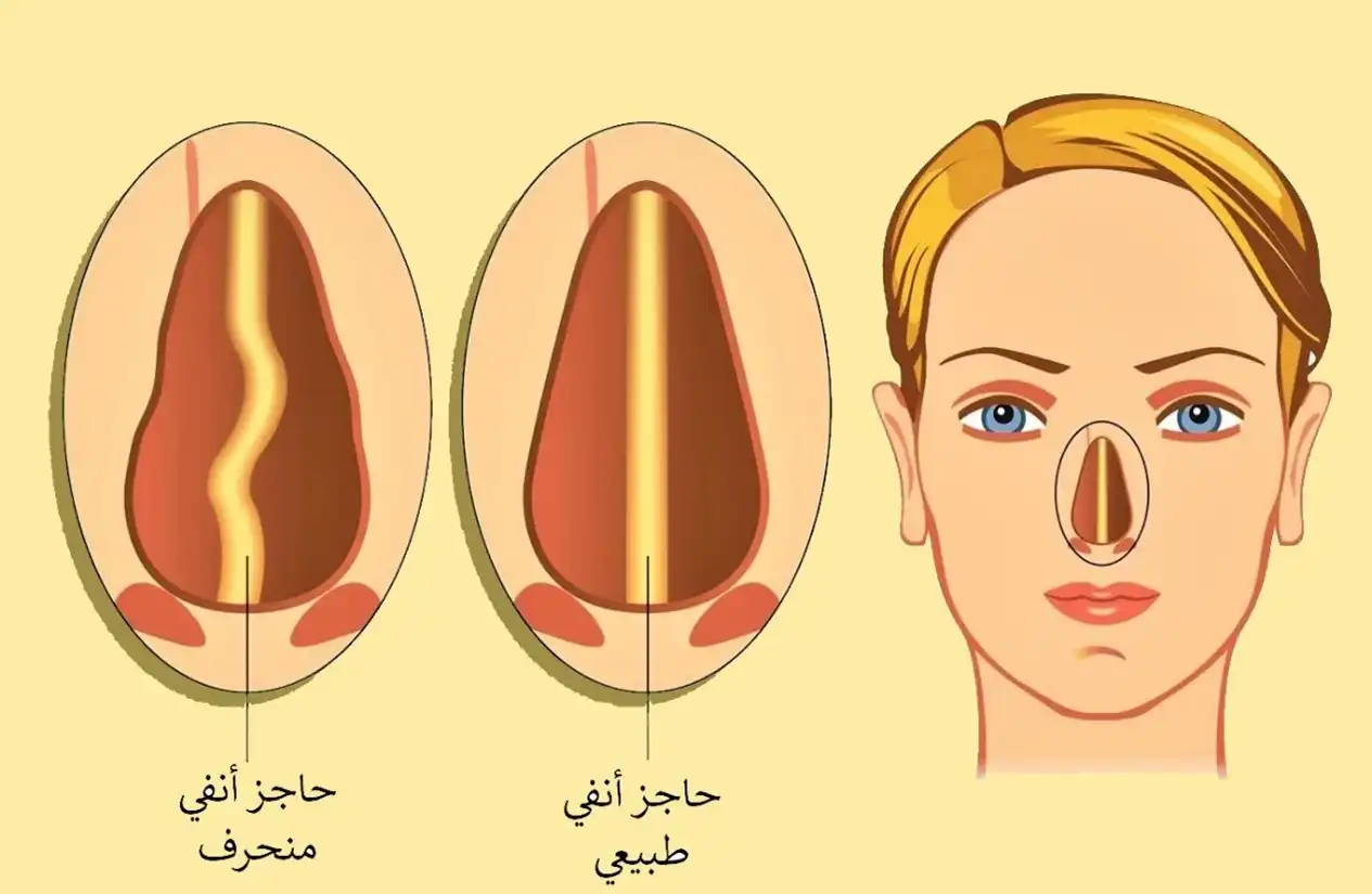 Normal nasal septum and deviated nasal septum