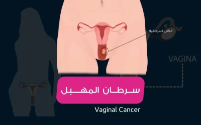 Vaginal cancer causes, symptoms and treatment
