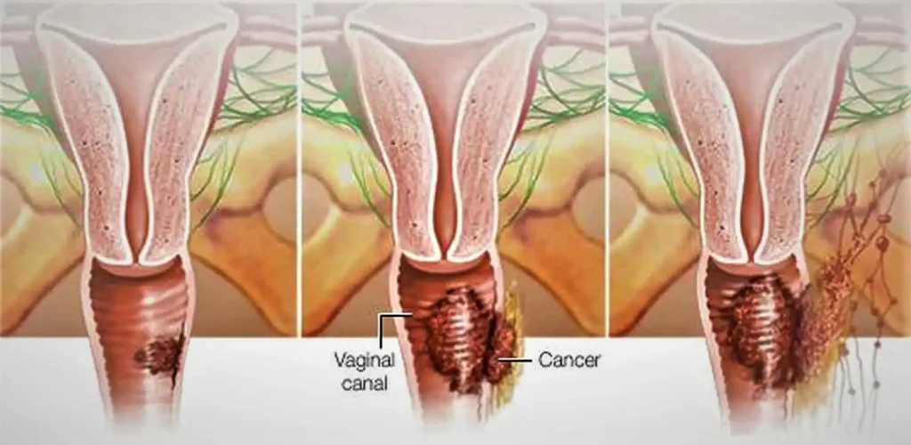 vagina cancer