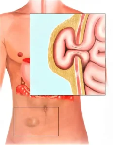 An image showing an abdominal hernia