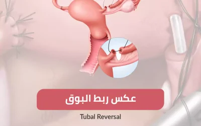 Reverse tubal ligation