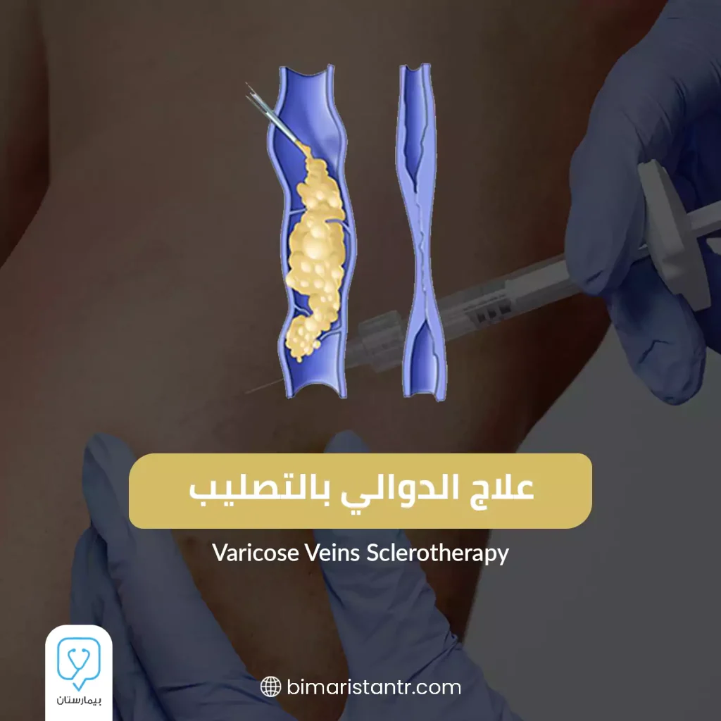 Varicose veins treatment by sclerotherapy (injection) in Turkey