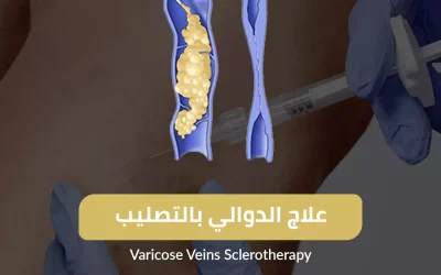Varicose veins treatment by sclerotherapy - how to treat varicose veins by injection