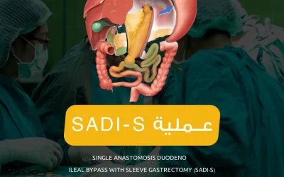 مفاغرة مفردة مع تكميم المعدة (SADI-S)