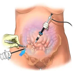 Laparoscopic treatment of abdominal hernia