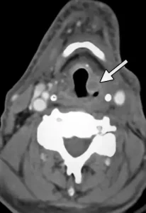 صورة طبقي محوري تظهر سرطان الحنجرة الخبيث 