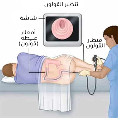 How to perform a colonoscopy