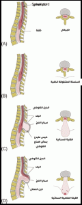tethered spinal cord