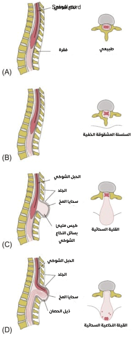 Picture of vertebral deformities that cause  Hydroceles of different content