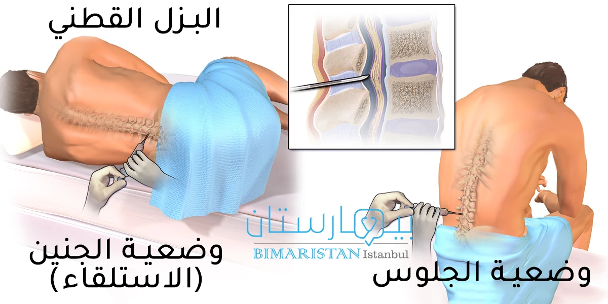 Lumbar puncture positions and where the puncture needle is inserted