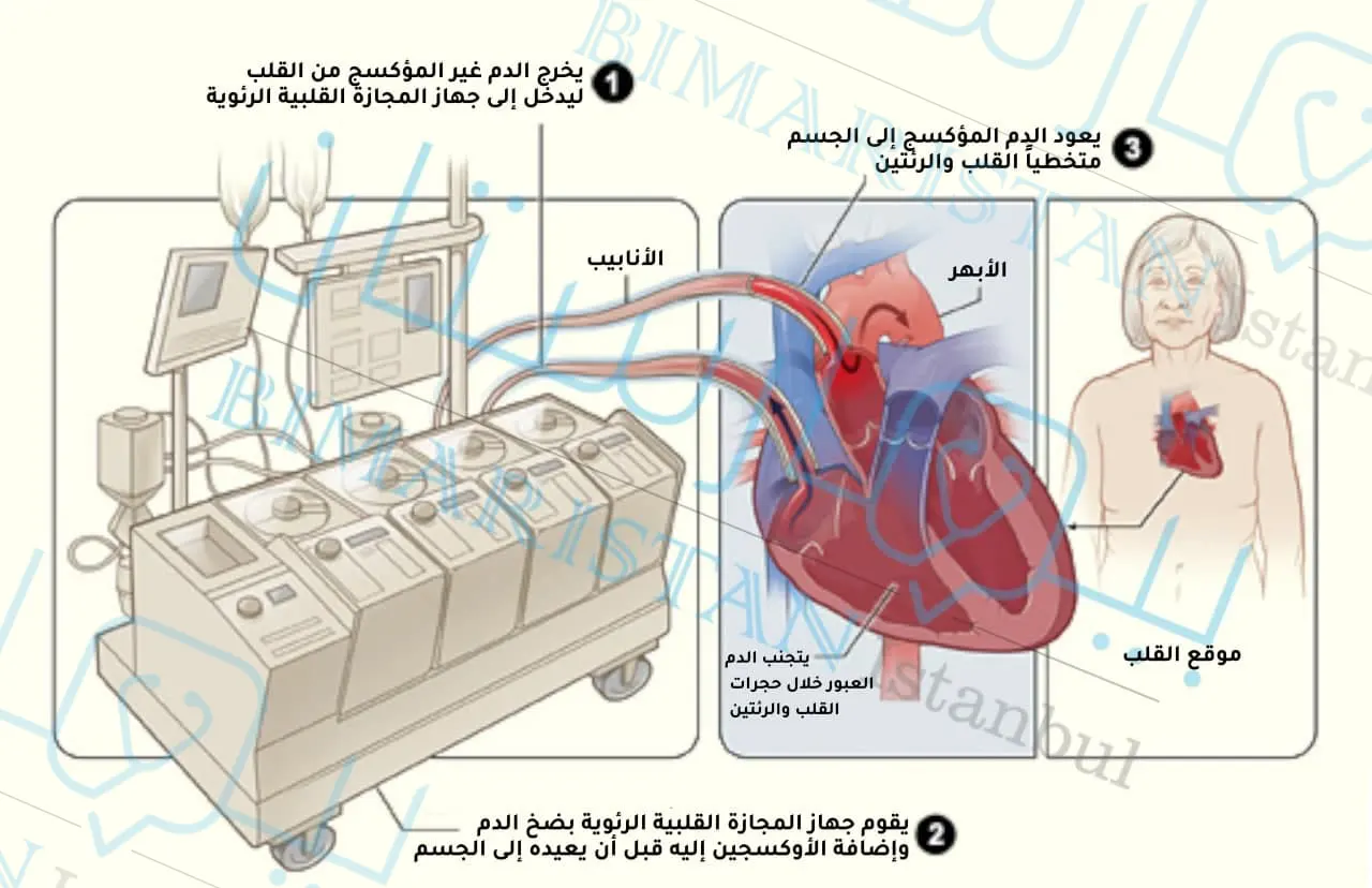 يعمل جهاز المجازة القلبية الرئوية عمل القلب والرئتين في ضخ الدم وأكسجته