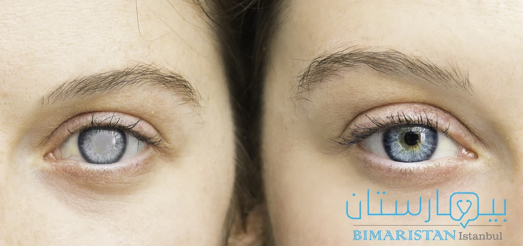 الفرق بين العين الطبيعية والعين المصابة بالزرق (عملية المياه الزرقاء في العين)