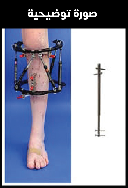 جهاز التثبيت الخارجي (جهاز إليزاروف) ومسمار التثبيت الداخلي الذي يوضع جراحياً داخل العظم حيثُ يستخدم كلاهما في عملية تطويل العظام