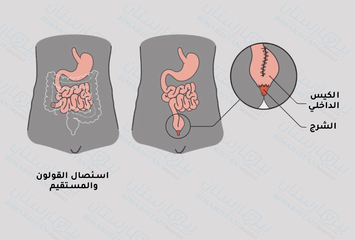 Treatment of ulcerative colitis by resection of the colon and rectum and formation of the internal cyst