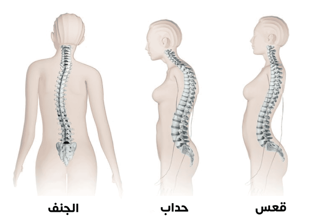 The difference between different spinal deformities