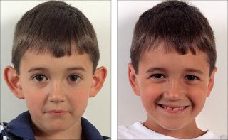 A picture of a child before and after the treatment of bat ear without surgery in Turkey