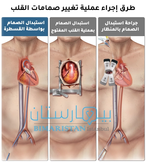 يمكن إجراء عملية تغيير صمامات القلب في تركيا بالمنظار أو بعملية القلب المفتوح أو بواسطة القسطرة