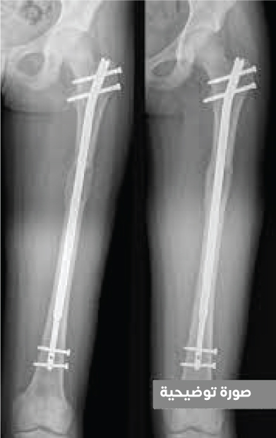 Kemiklerin daha sonra içinden uzatılması için kemiğin içine cerrahi olarak yerleştirilen iç vidayı gösteren bir radyografi