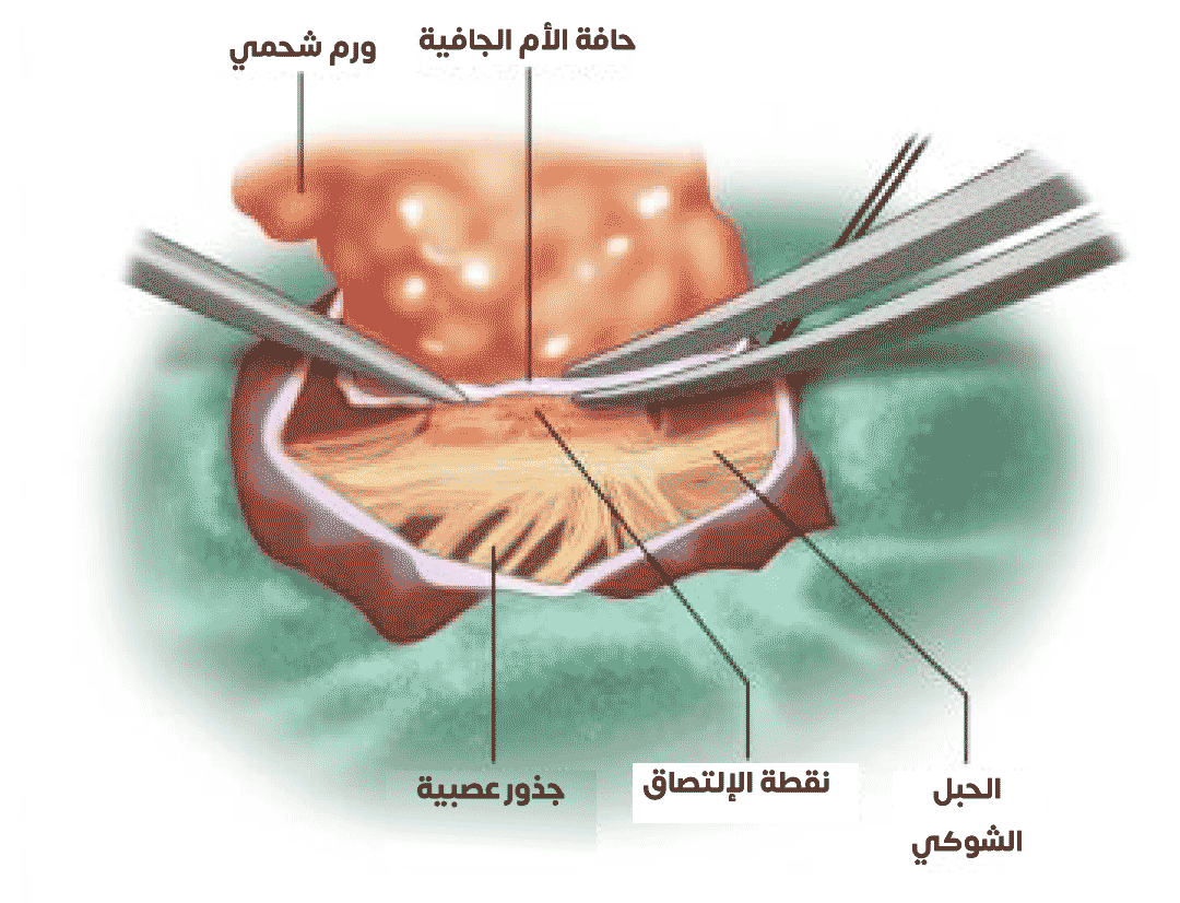 Bir lipomaya bağlı omuriliğin çözülmesi sürecini gösteren resim