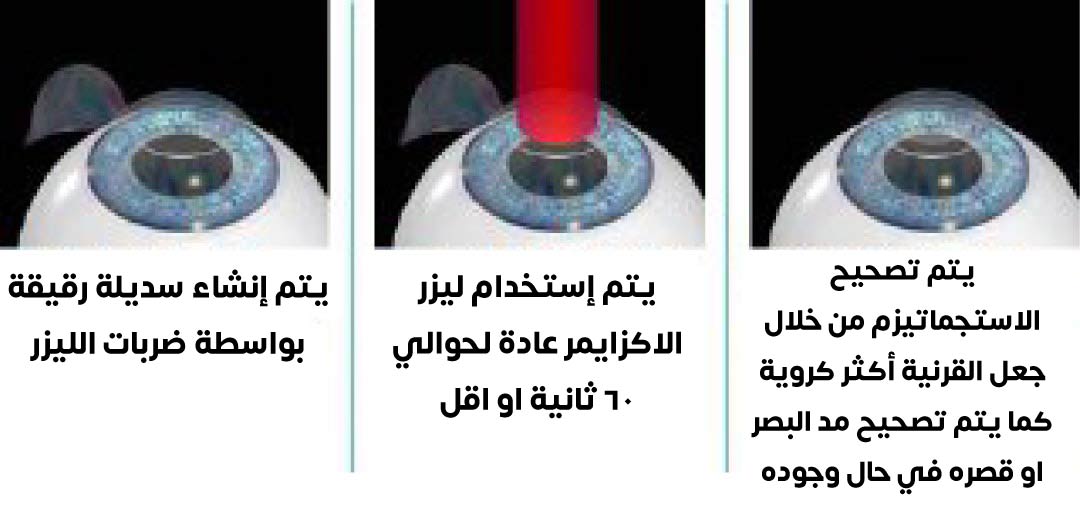 A picture showing the stages of the LASIK process and how it is performed
