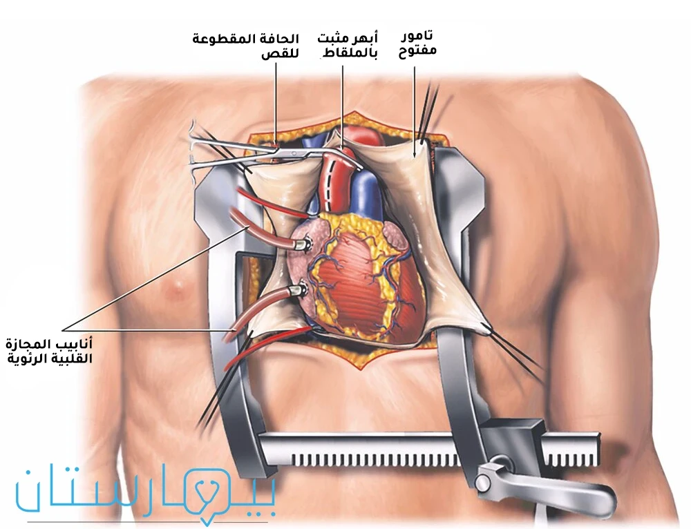 The heart is connected to a cardiopulmonary bypass machine to keep the heart working during the aortic valve replacement