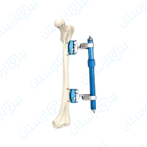 Holifex device that is attached to the bone, which is used in the process of bone lengthening in Turkey