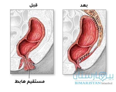 Comparison between rectal prolapse and normal condition after rectal prolapse repair