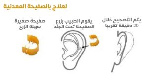 yarasa kulak tedavisi