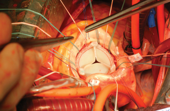 Aort kapak değiştirme ameliyatı