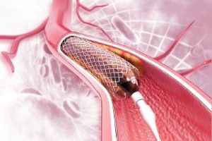Stent used in the treatment of coronary artery stenosis through catheterization