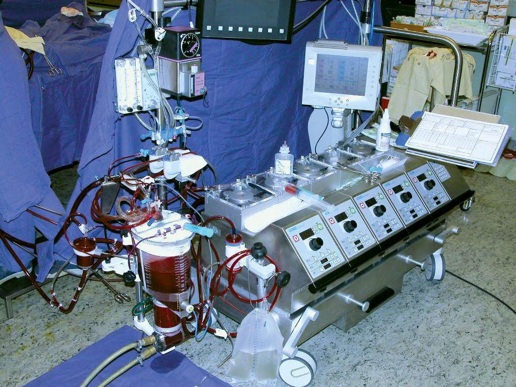 Açık kalp cerrahisinde kullanılan kalp pompası