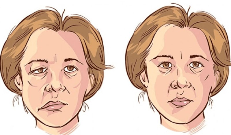 Illustration of the case of hemifacial spasm, corresponding to a picture of a normal face