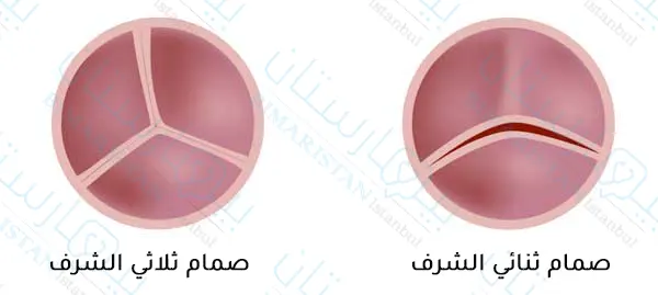 Bicuspid aortic valve shape