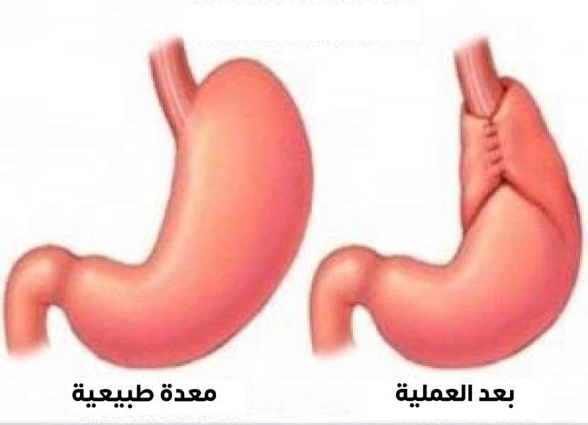Before and after Nissen operation used to treat hiatal hernia and prevent GERD