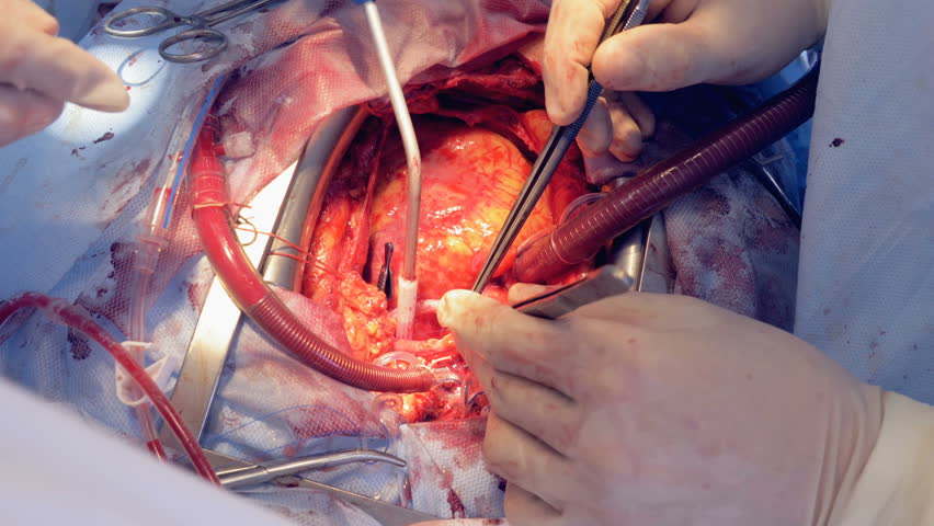 طبيب يقوم بتنفيذ عملية القلب المفتوح في تركيا